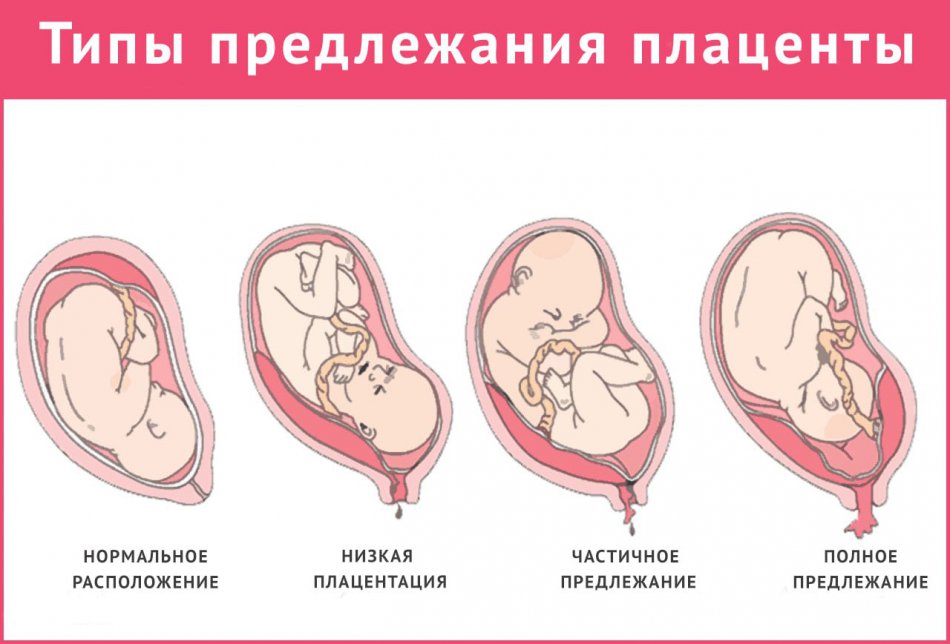 Типы предлежания плаценты