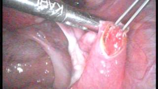 Внематочная трубная беременность: лапароскопия