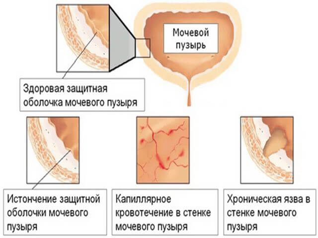 болезнь мочеполового отдела