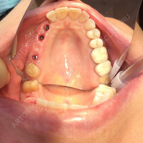 имплантация зуба в клинике АРТОКС