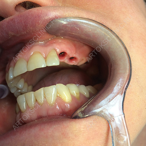 фото зуба до имплантации