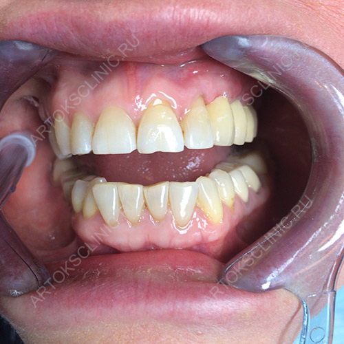 зубы после имплантации