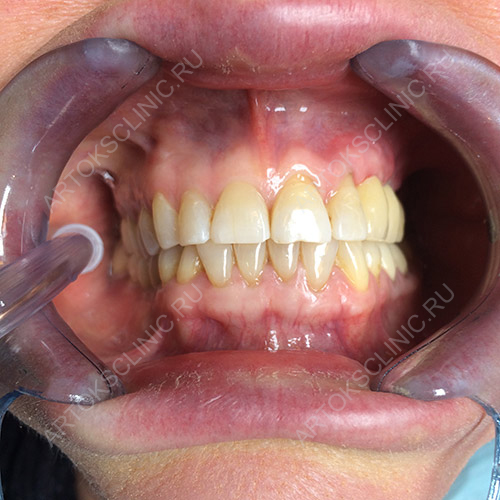 имплантация зубов в москве