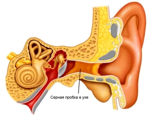 Особенности ушных пробок