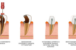 Схема наращивания зубов на штифте