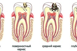 Стадии кариеса зубов