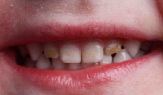 Черный налет на зубах ребенка