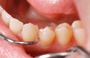 удаление зубных отложений