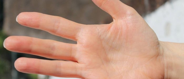Как лечить ушиб пальца на руке