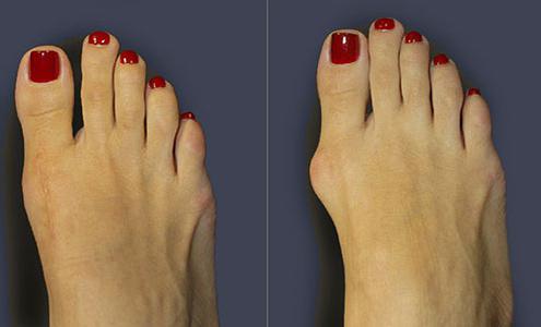 лечение вальгусной деформации большого пальца стопы 
