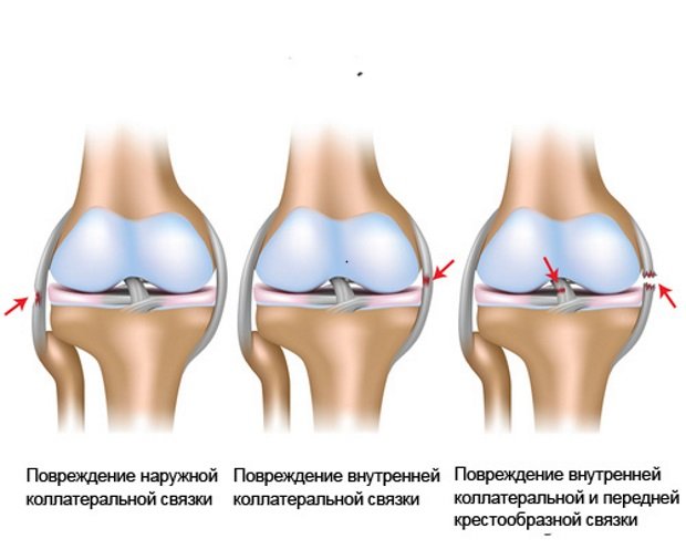 Виды повреждений связочного аппарата