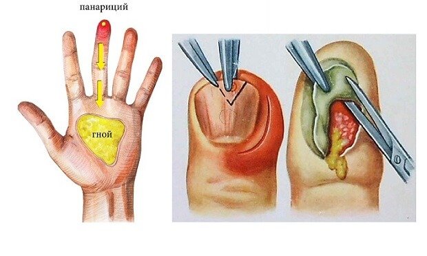 лечение ногтя