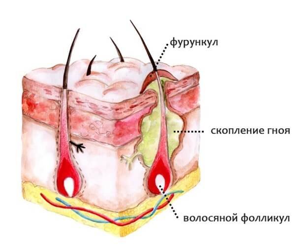 Фурункулез на коже