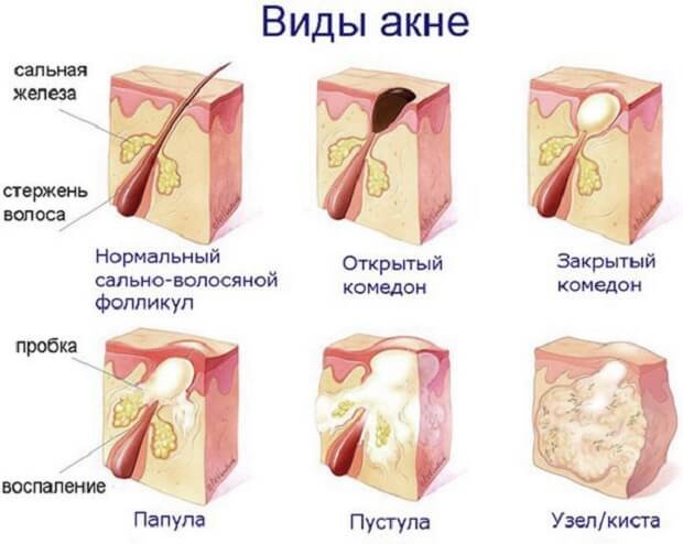 Типы акне