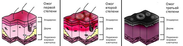 Типы ожогов