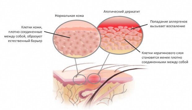 Формирование атопического дерматита