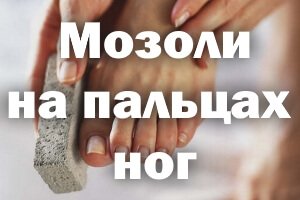 Мозоли на пальцах ног