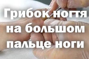 Лечение грибка ногтя на большом пальце ноги