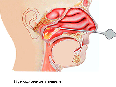 Пункционная операция при гайморите