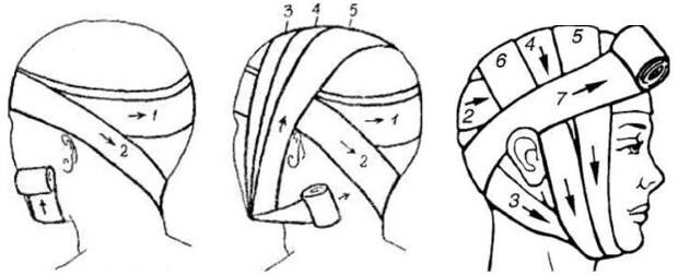 Схема наложения повязки