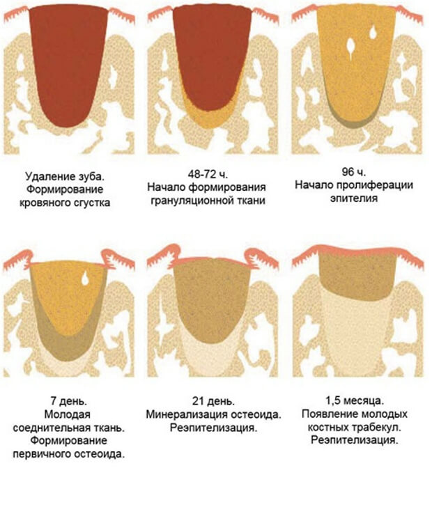 Этапы заживления ткани после удаления зуба