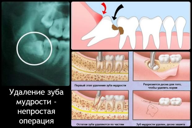 Удаление зуба мудрости