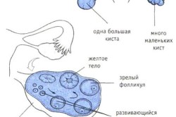 Кистозное образование желтого тела как патология придатков надъяичникового типа