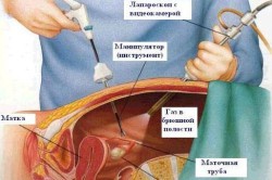 Лапароскопическая операция кисты яичника