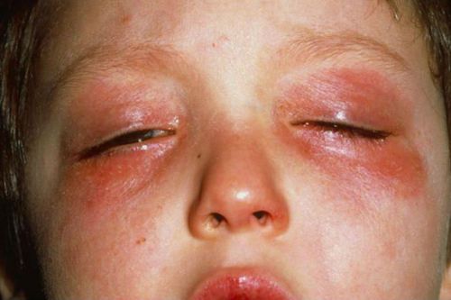 Аллергический конъюнктивит у ребенка