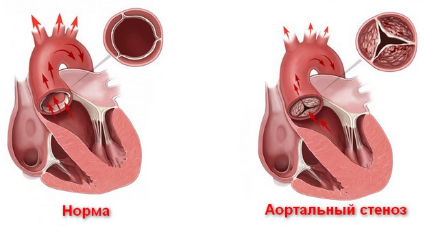 стеноз аорты что это такое