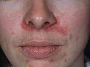 Чем может быть спровоцировано шелушение и покраснение вокруг носа?