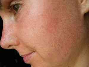 Красные пятна на лице шелушатся из-за проблем со здоровьем