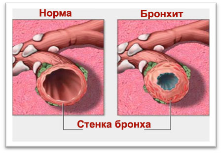 бронхит