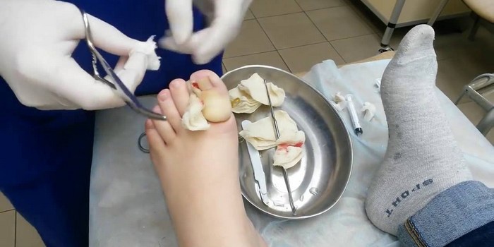 удаление вросшего ногтя хирургическим способом
