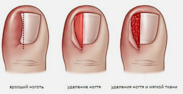 хирургическое лечение вросшего ногтя