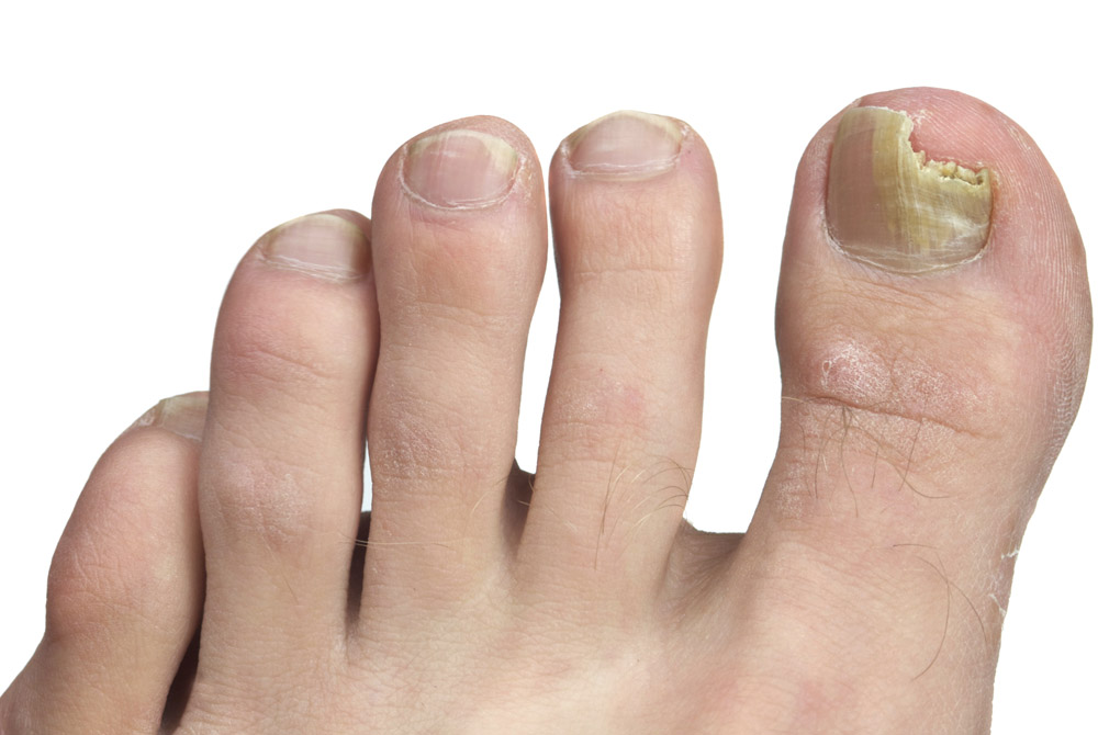 Грибок — частая причина вросшего ногтя