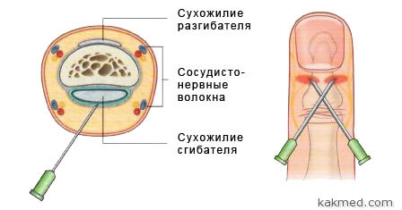 Онихокриптоз