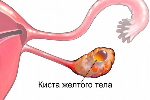 киста желтого тела