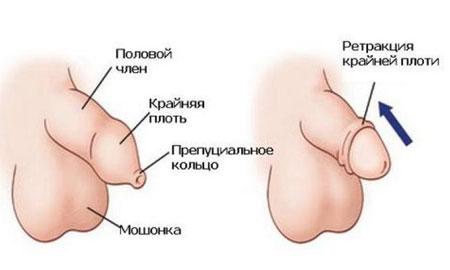 Характеристика фимоза 