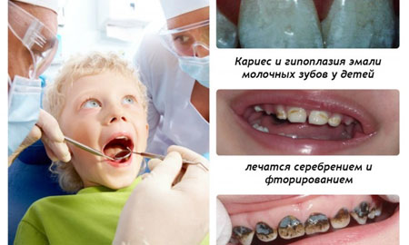  Серебрение зубов 