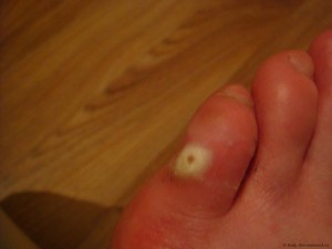 Воспаление пальца ноги возле ногтя