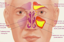 Воспаление пазух при гайморите