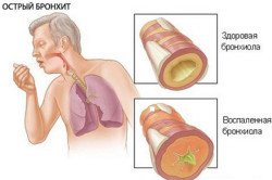 Бронхит - заболевание верхних дыхательных путей