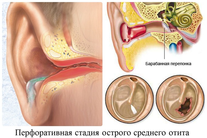 отит