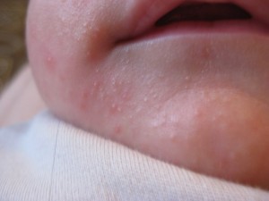 Мелкая сыпь на лице у грудничка