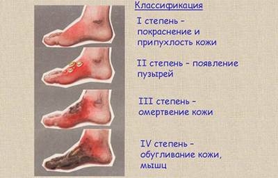 Первая помощь при ожогах