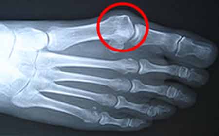 Диагностика боли в области большого пальца на ноге