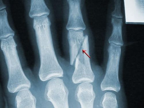 Перелом пальца на рентгене
