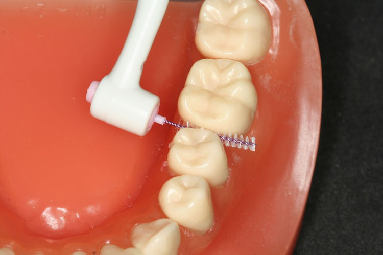 Profilaktika-zubnogo-naleta.jpg