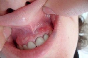 остеомиелит зуба
